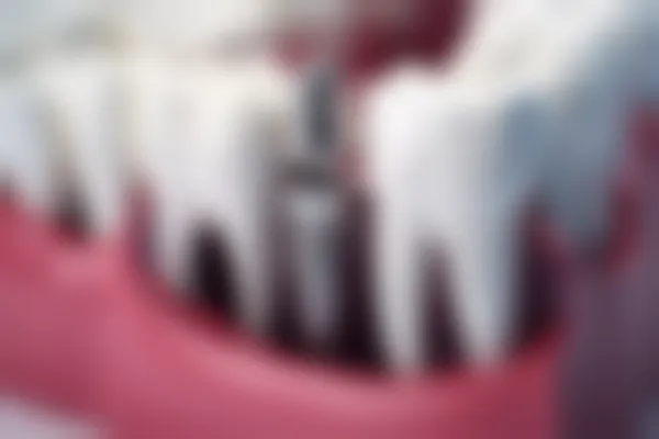 重庆牙卫士口腔医院（星天广场）现推出限时优惠，地包天治疗费用由3000元起降至仅需2500元起，助您快速解决牙齿烦恼，重拾自信微笑！