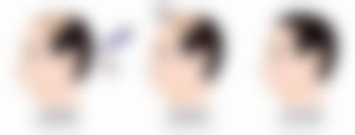 脸上有黑色疤痕怎么去除：费用解析与精打细算