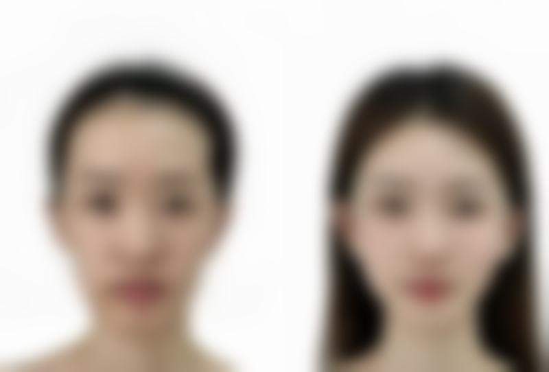 做了埋线双眼皮以后眼皮会松弛吗