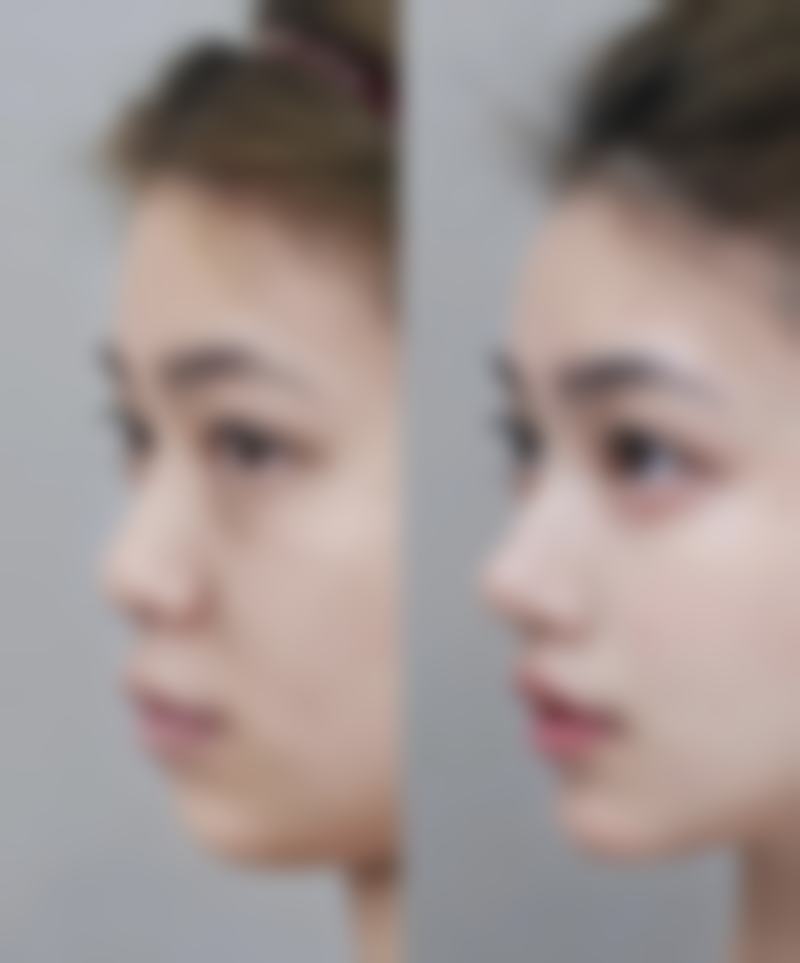 做了双眼皮以后眼皮会松弛吗？埋线全切护理不当真会加速衰老吗