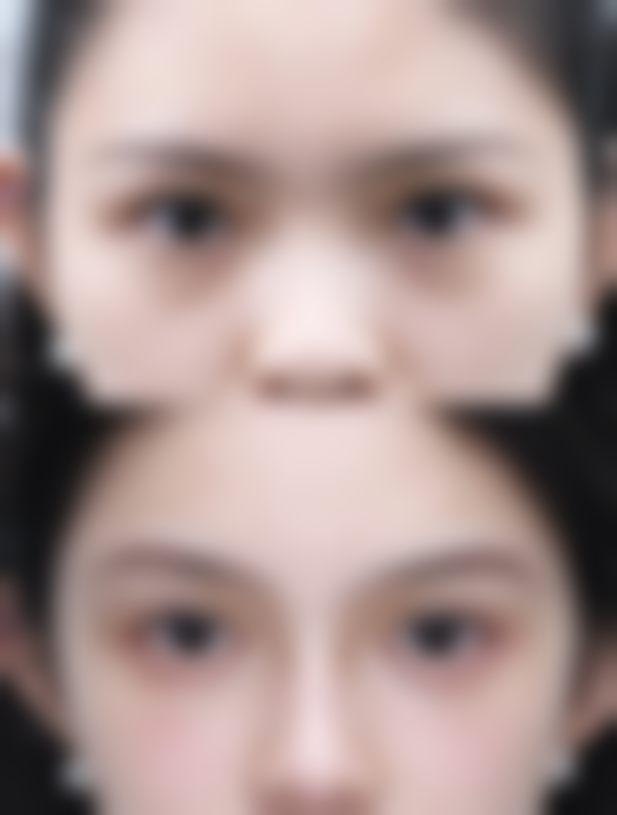 做了双眼皮多年以后眼皮会松弛吗