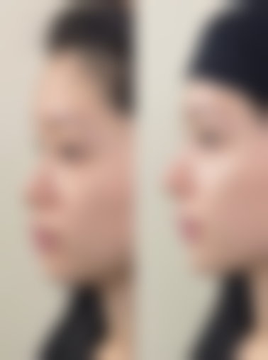 膨体隆鼻：高性价比与长久成效的权衡