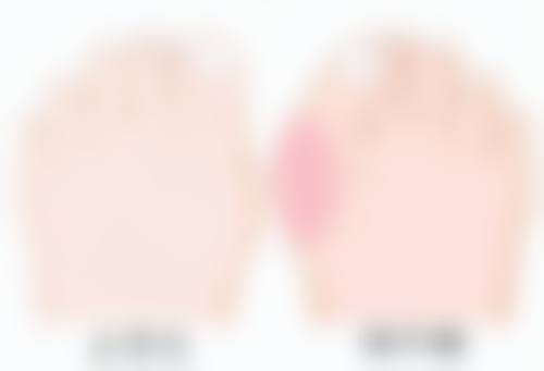 医院详解手术治疗：完全告别顽固眼袋