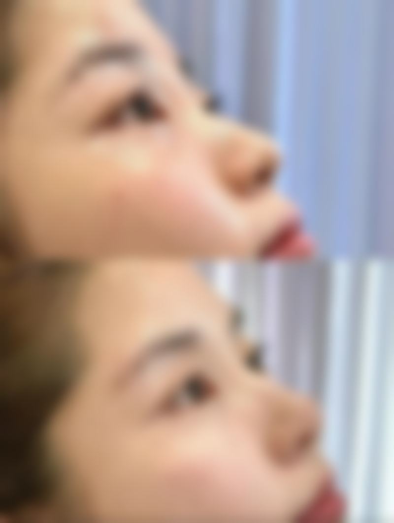 减肥对割双眼皮有影响吗？减重40斤后皮肤松弛会改变效果吗