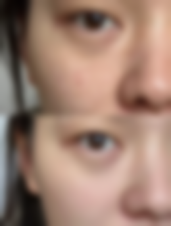 严重黑眼圈眼袋怎么去除？玻尿酸填充+手术祛除，告别熊猫眼显年轻