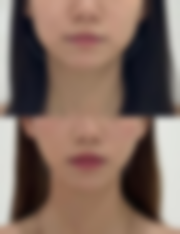 激光祛黑疤：高新科技武器精细打击黑疤