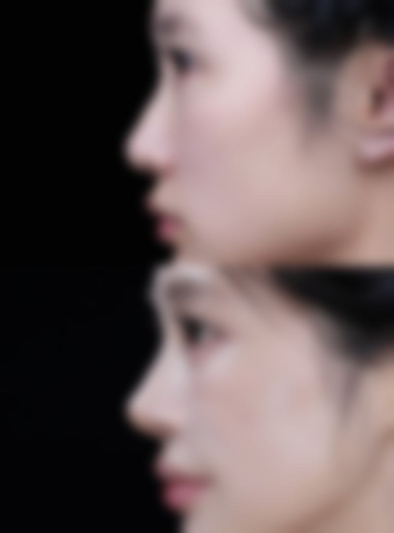 双眼皮拆线后祛疤膏的正确涂抹方法