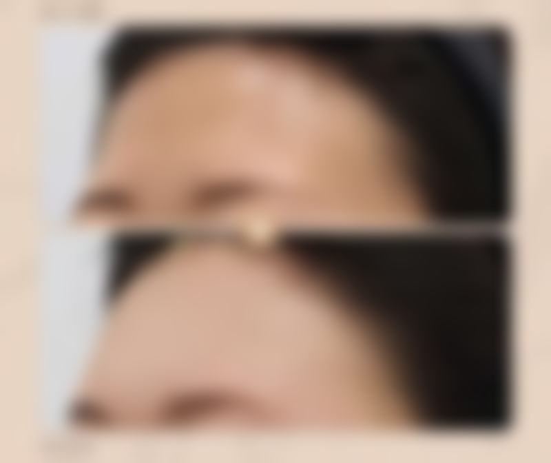 抽脂去眼袋好不好——医生技术篇