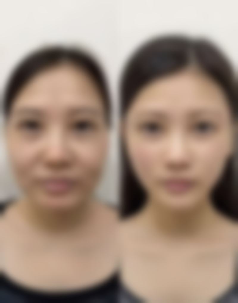 日常护理：细心呵护，为祛疤成效添砖加瓦