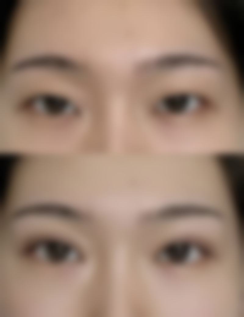 抽脂去眼袋好不好——价格篇