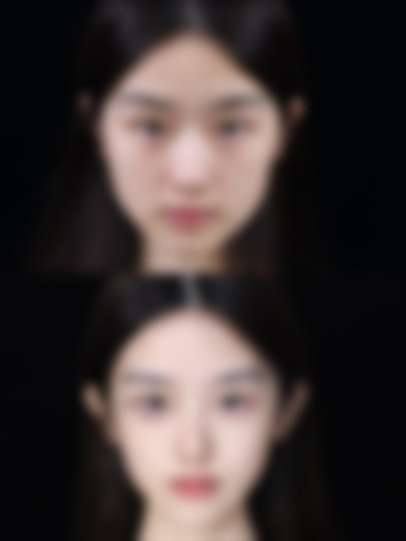 去完眼袋有皱纹,术后避免刺激特别重要