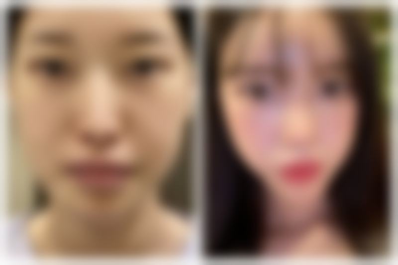 去完眼袋有皱纹,术后复诊检查别忘记