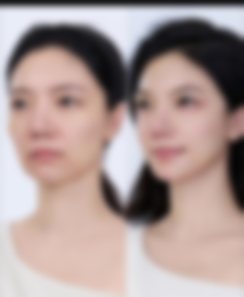 去完眼袋有皱纹,术后冷敷消肿有必要