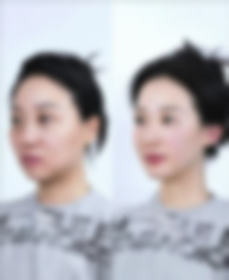 去完眼袋有皱纹,术后护理不当惹的祸?