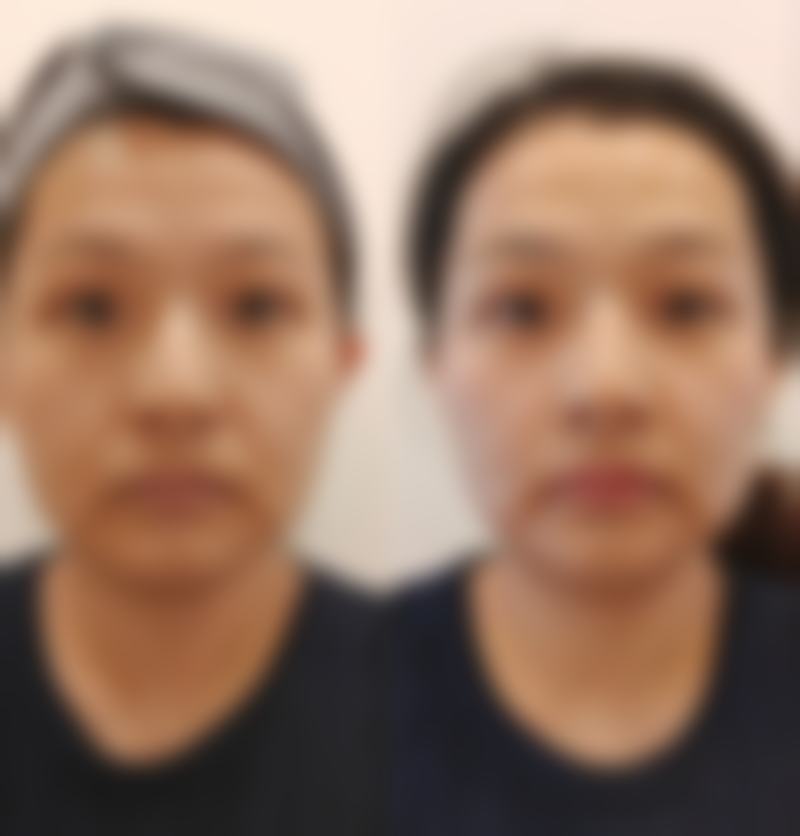 遗传性眼袋祛除后,如何防止卷土重来?