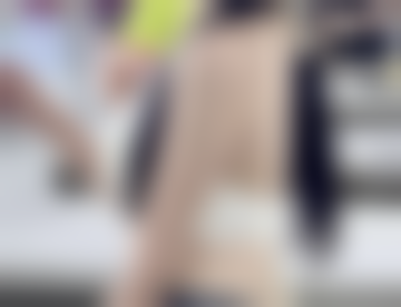 眼袋祛除后激光治疗能否杜绝再生?