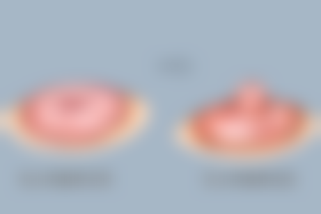 基础疾病患者假体隆胸:风险与应对策略