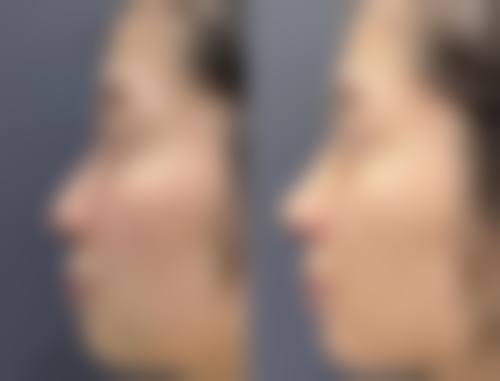 除眼袋什么方法最安全最好？激光VS手术大PK，安全系数对比+术后护理全攻略