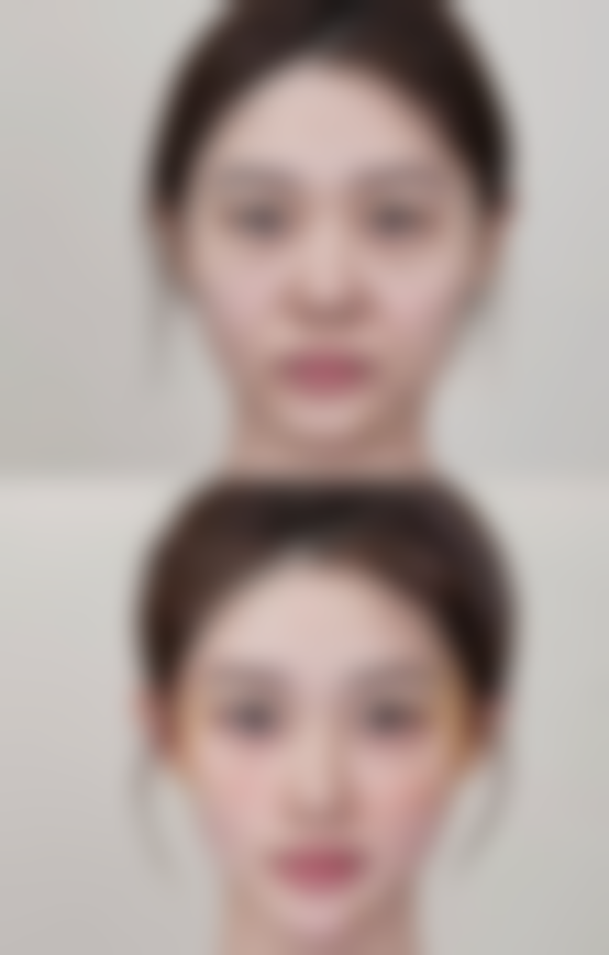 除眼袋什么方法更安心更好：澄清误区与专精建议