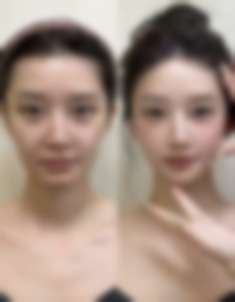 告别泡泡眼，重获明亮双眸