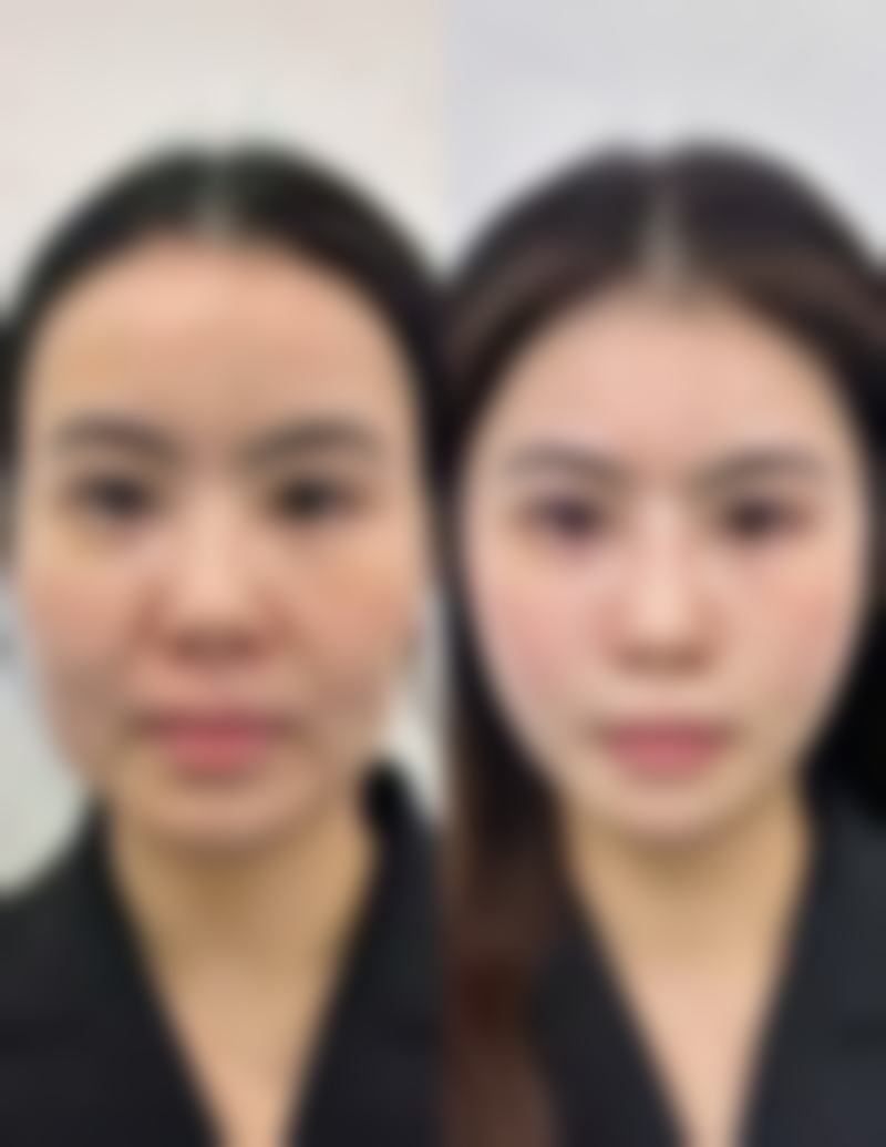 手术过程中假体隆胸:潜在风险与医生职责