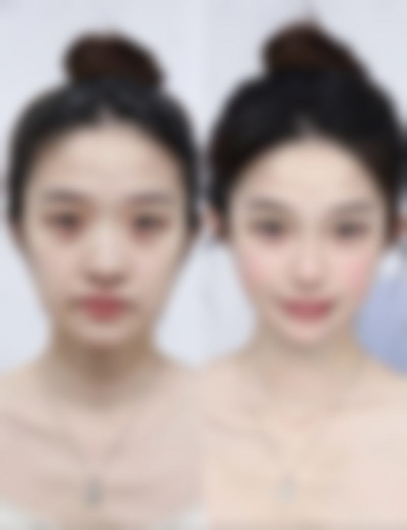 中医调理疤痕性痘痘：从内而外的战痘智慧