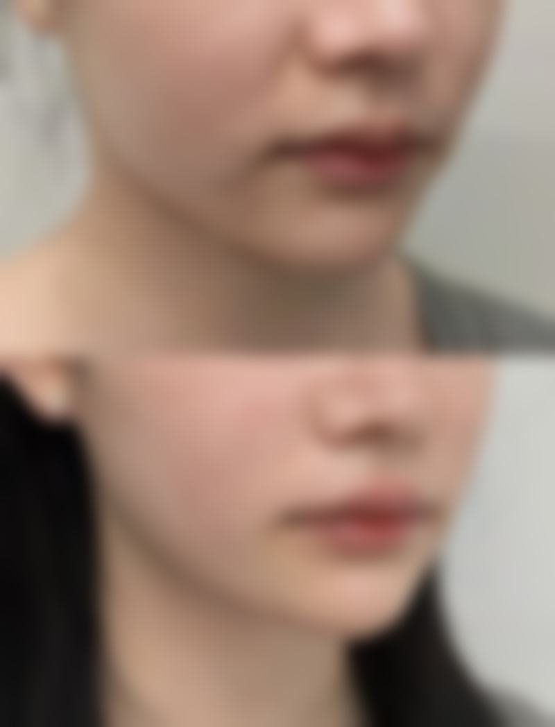 新生儿多久单眼皮变双眼皮的科学建议与温馨提示