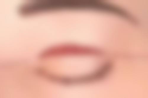 辽宁杏林整形外科医院解析割完双眼皮后三个月修复自然概率