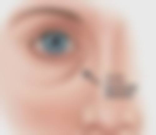 割完双眼皮后多久恢复自然？1个月消肿3个月定型，饮食护理加速恢复