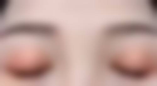 去眼袋有哪些风险：留疤风险，疤痕体质者的术后困扰