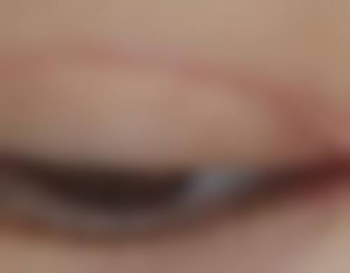 割完双眼皮后多久修复自然