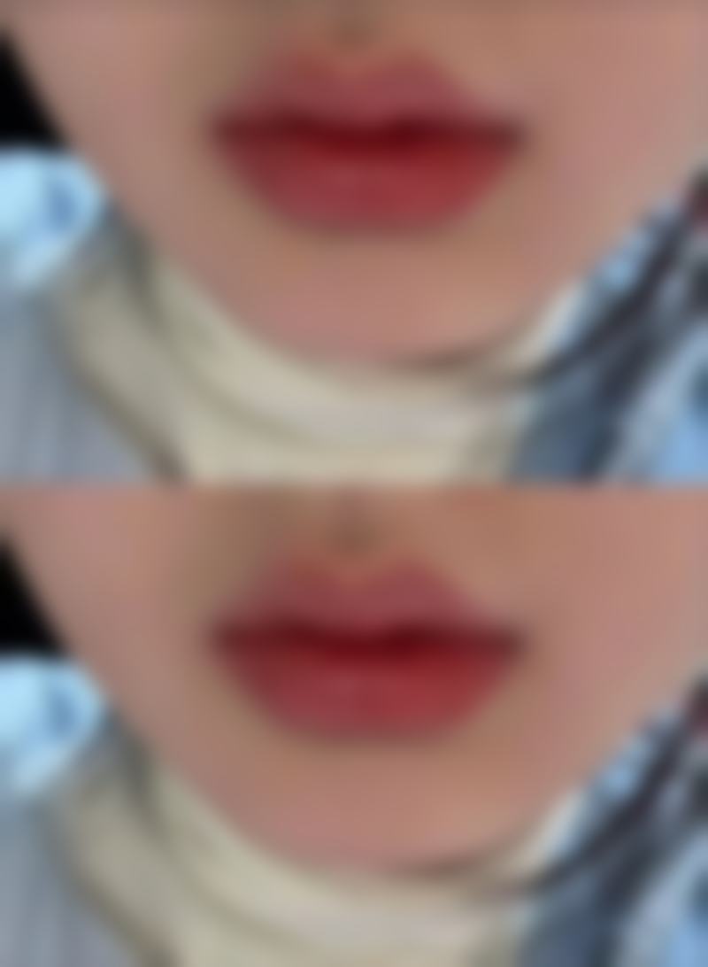 张川医生谈割完双眼皮后半年能否修复自然