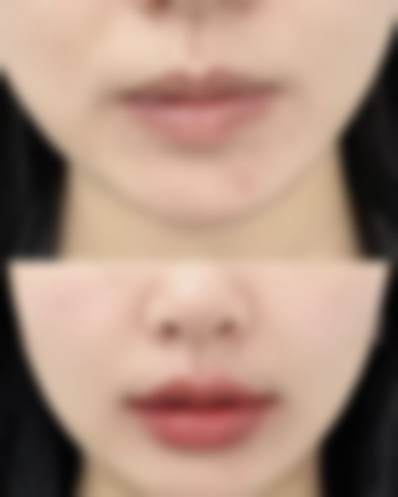 去眼袋有哪些风险：成效不佳风险，眼袋去除不完全或复发的无奈