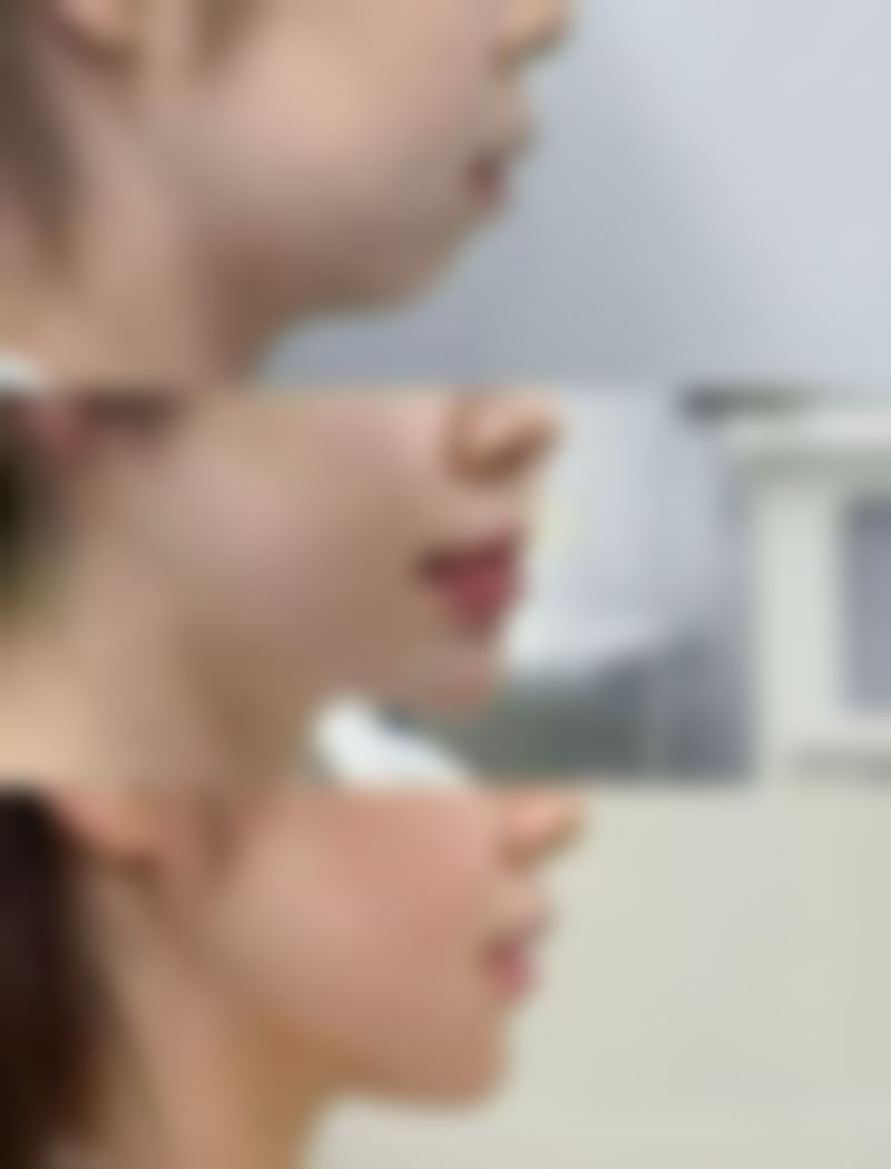 对比不同割双眼皮方式后多久修复自然