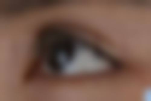 用什么能去除疤痕：微针技术——唤醒皮肤的“自我修复力”