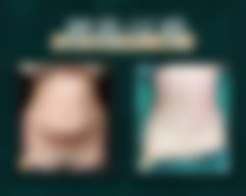 广州高尚医学美容中 心程飞手术风格之三等甲设备：给手术加个“物理外挂”