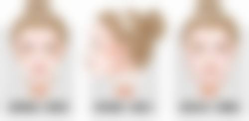 烧伤疤痕增生变软是好的征兆吗