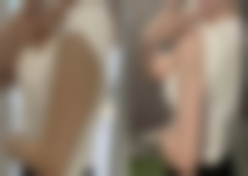 双眼皮后冰敷频率因手术方式而异，这份时间表快收藏