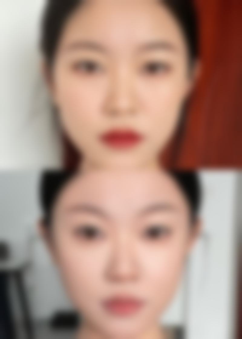 用什么能去除疤痕：不同类型疤痕的克星清单