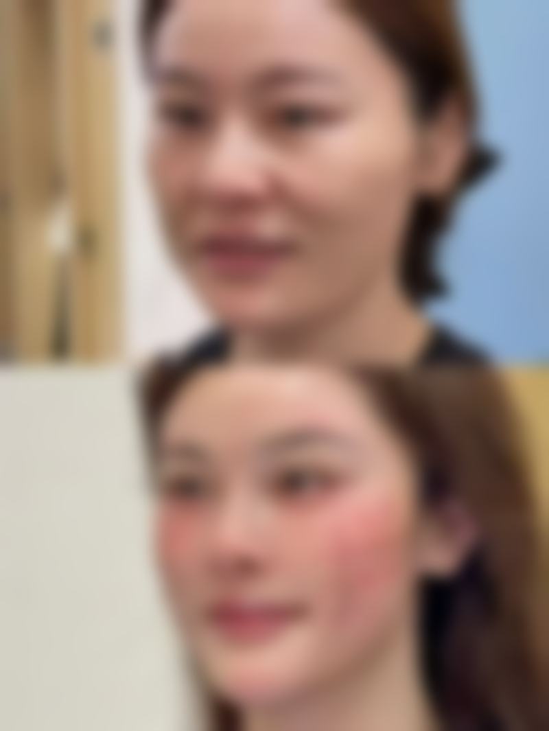 疤痕增生变软到何种程度为好征兆