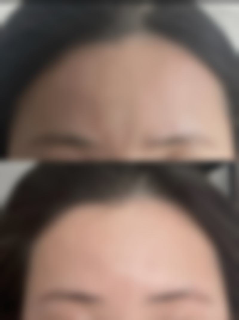 双眼皮后48小时后呢？热敷接棒的时间点