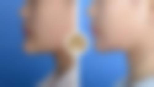 瘦脸针脸下垂怎么办:预防胜于治疗