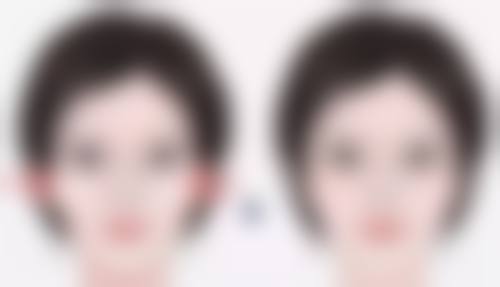 重度的眼袋怎么去：激光治疗——无创的“光之魔法”