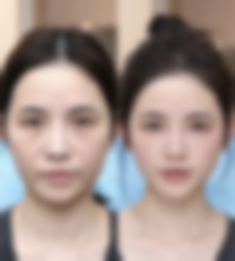 吸脂全麻对神经系统的危害：大脑的“重启困扰”