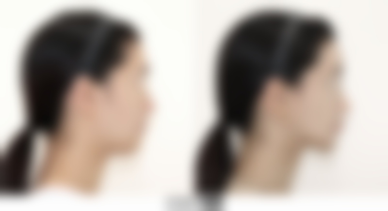 面部吸脂完全修复前谨慎试探(1 - 3个月):小心尝试忌口食物