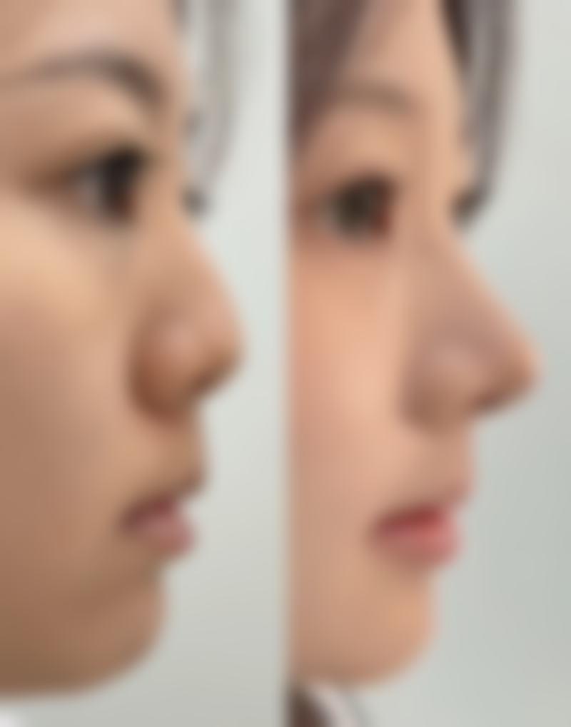 如何最好快速除去眼袋，3天消肿秘籍+医美手术全攻略