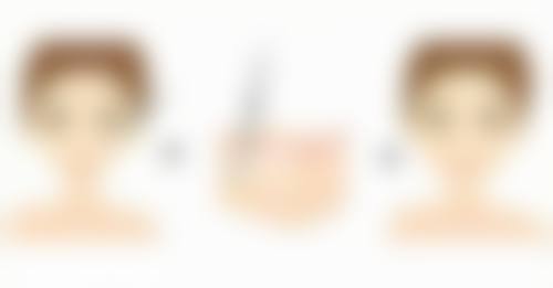 打瘦脸针脸肿：消肿时间的常规与特殊情况