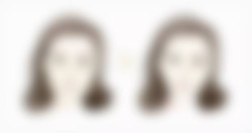 线提升隆鼻吸收完的时间受哪些因素影响之多方面揭秘