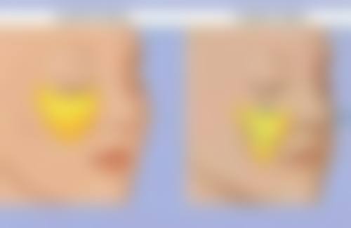 适合光子嫩肤治疗的疤痕类型