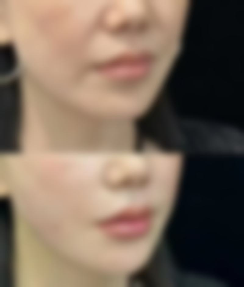 线提升隆鼻蛋白线多久会吸收完之蛋白线的奥秘